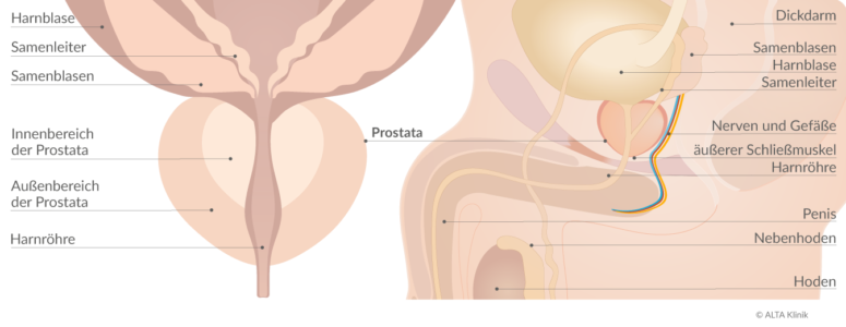 Prostata-Schaubild Prostatakrebs